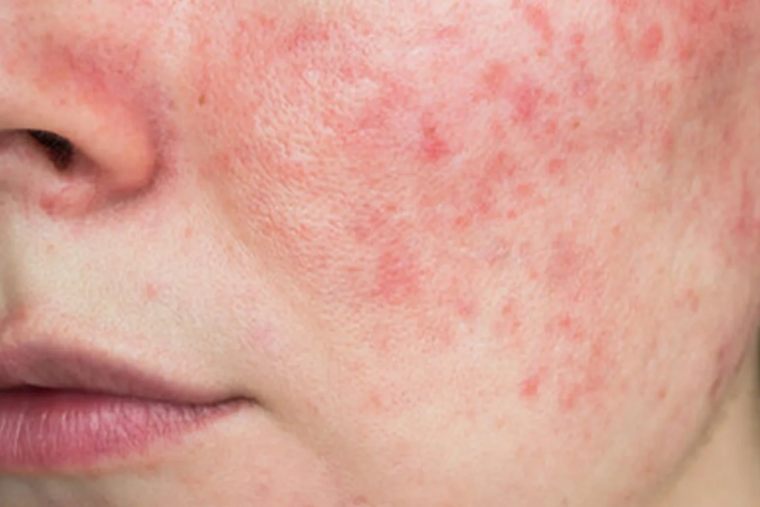 Acne en acnebehandelingen Huidkliniek Gaaf